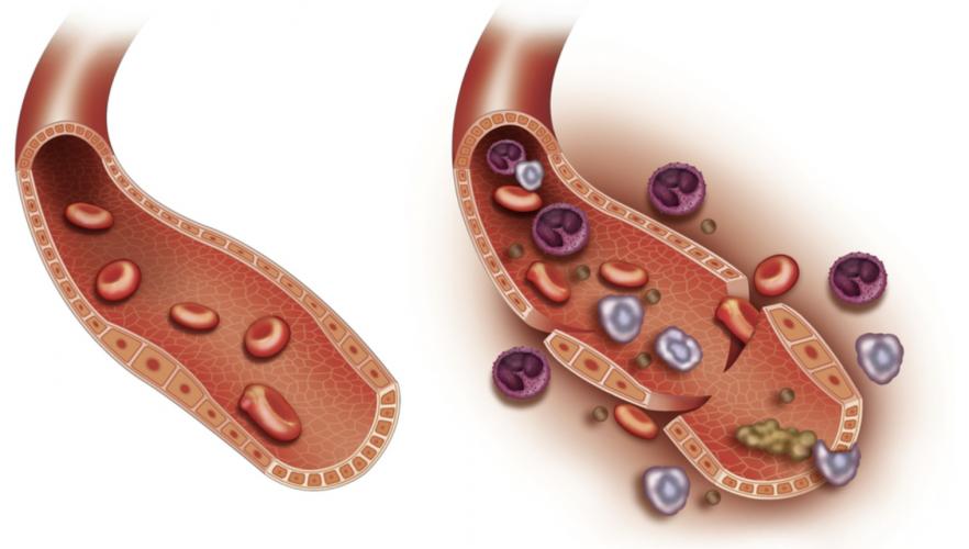 Enfermedad autoinmune  