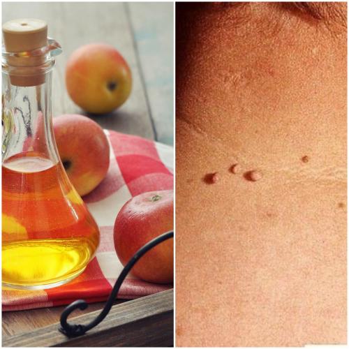 Zelf steelwratjes verwijderen 