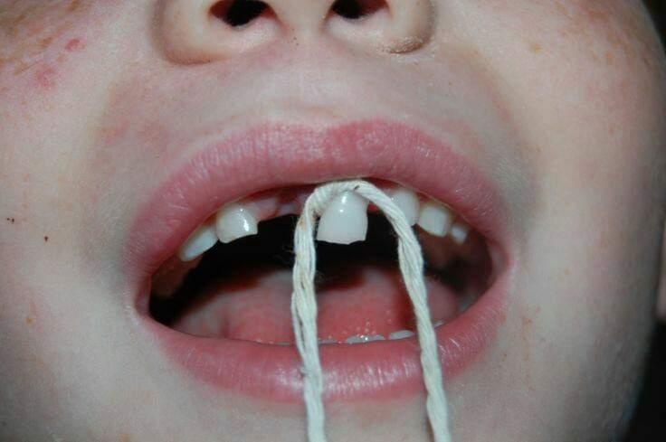 Een losse tand, zo deden we dat.