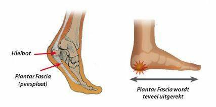 Heel spur symptoms