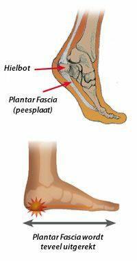 Heel spur symptoms