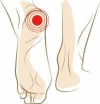 Heel spur symptoms