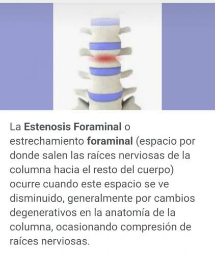 Estenosis foraminal