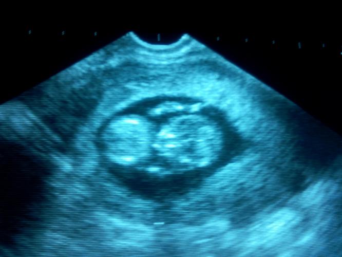 Leven met CREST-Syndroom 5: Echt waar?