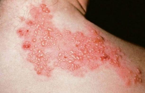 What is shingles?