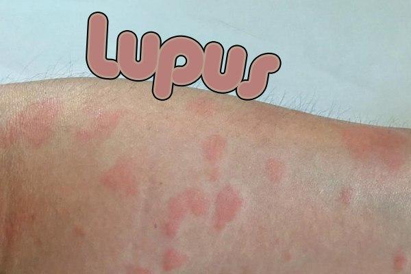 Lupus enfermedad autoinmune