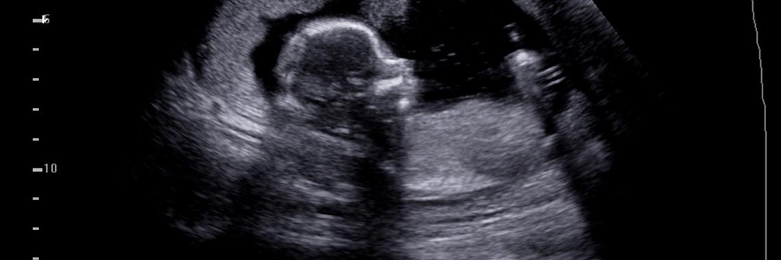 When Can You See Ultrasound Baby?