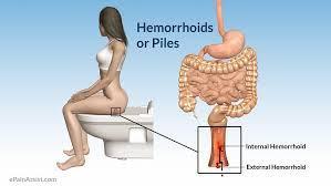 what is hemorrhoids