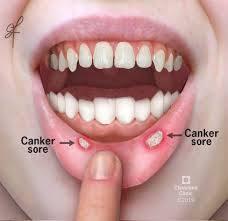 what causes canker sores