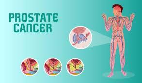 what are the symptoms of prostate cancer