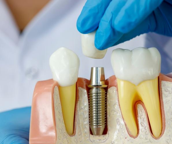 How much dental implants?