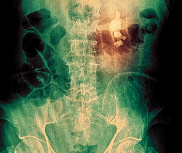 Kidney stone symptoms 