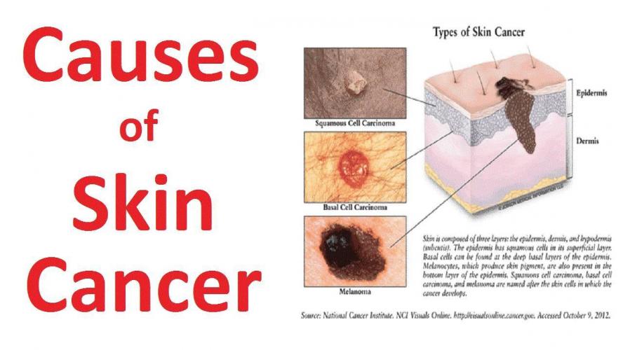 Causes for skin cancer