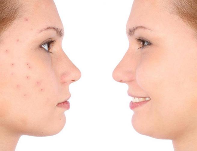 Which birth controls help with acne