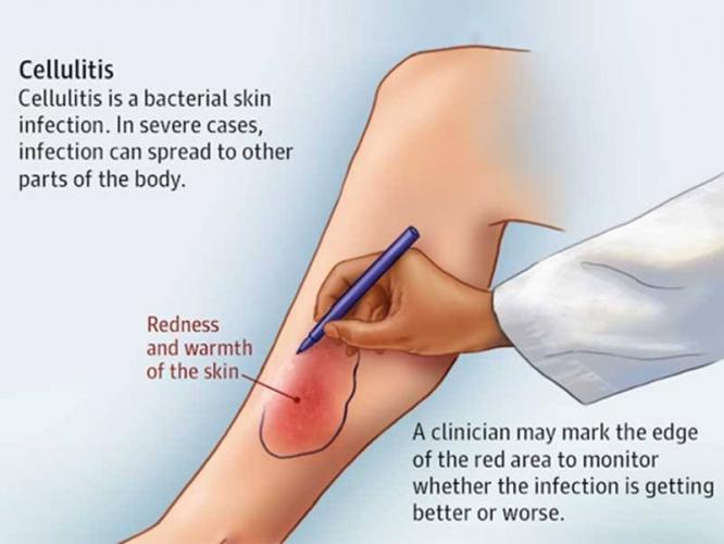 What is cellulitis?