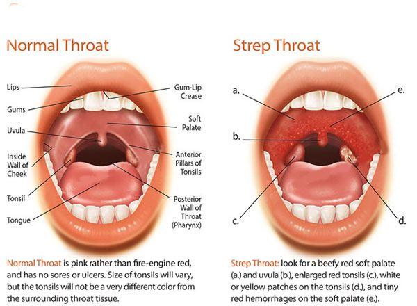 How to help a sore throat