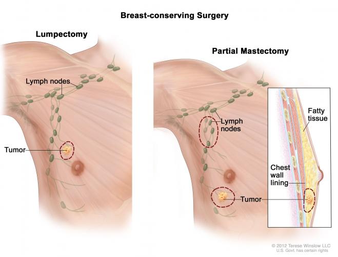 Breast cancer in Male