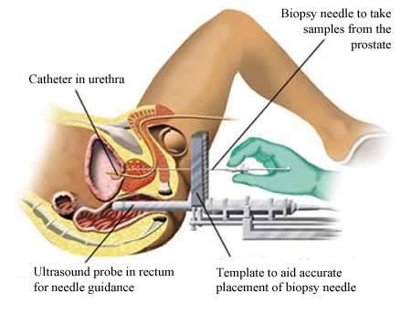 Survival rate of Prostate cancer
