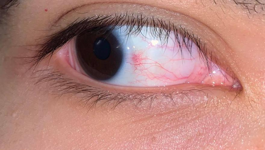 Why Do I Have A Red Spot On My Eye?