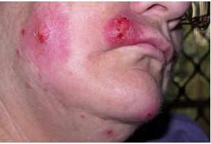 What Is Staph Infections