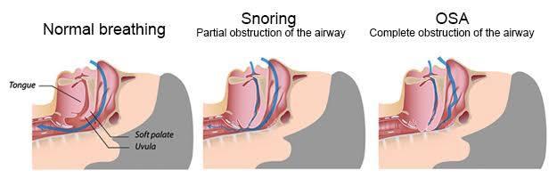 What is snoring?