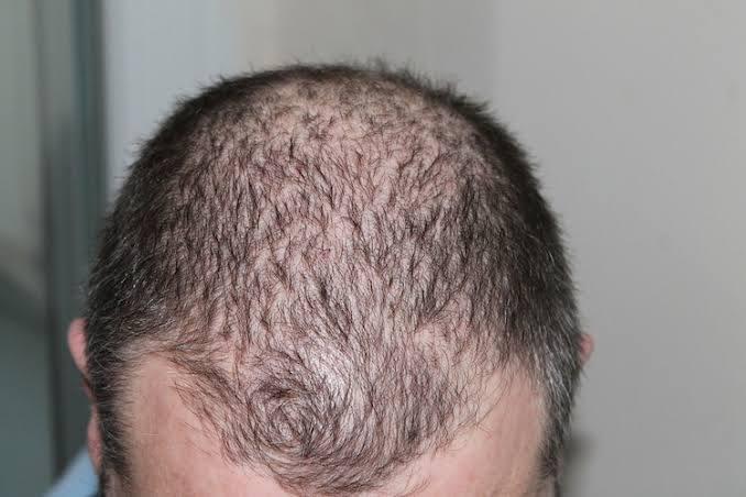 How to Stop Hair From Thinning.