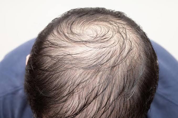 How to Stop Hair From Thinning.