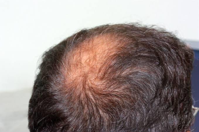 How to Stop Hair From Thinning.