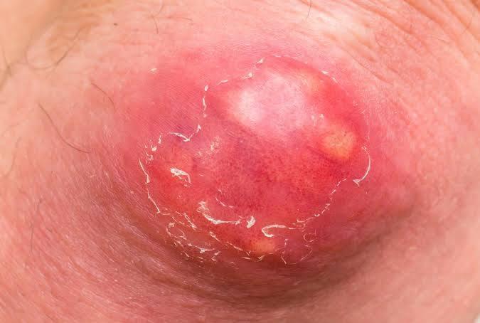 How to get rid of boils.