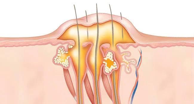 How to get rid of boils.