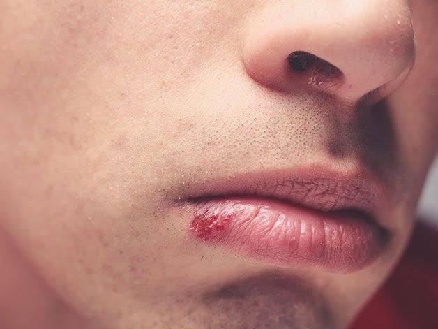 How to get rid of cold sore.