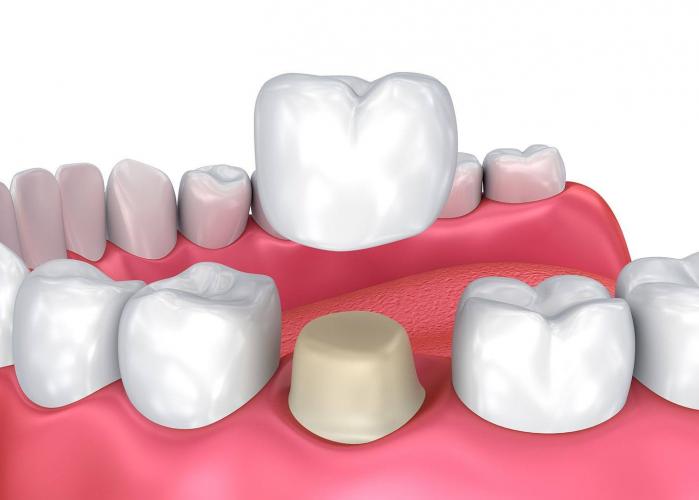 What is a tooth crown?