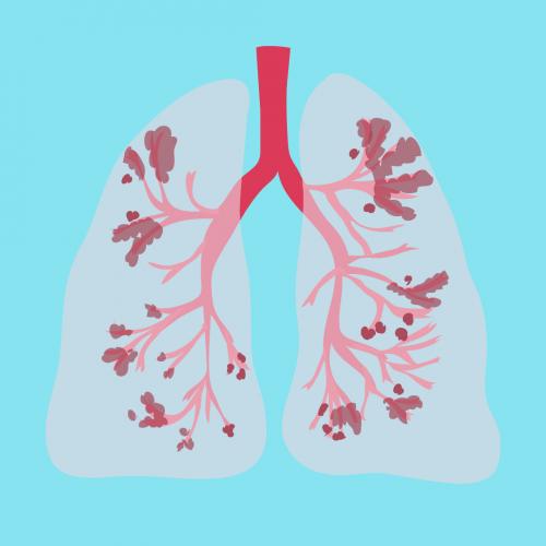 What is COPD symptoms?