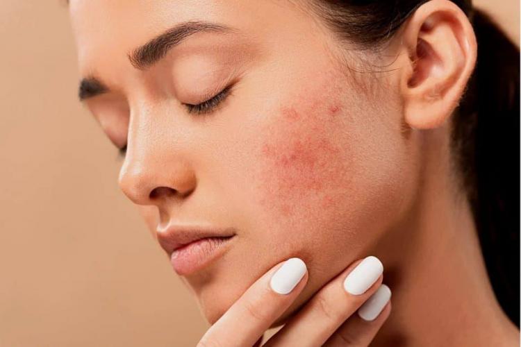  Natural remedies for acne