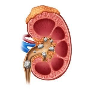 What is a kidney stone?