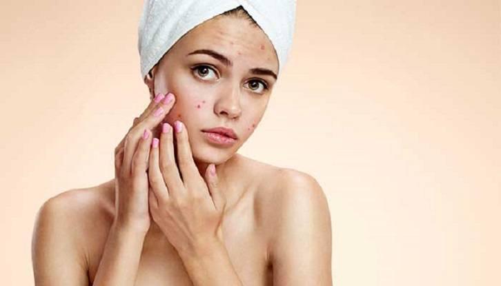 Top six home treatments for oily skin