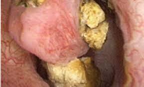 How Kidney Stones Are Formed