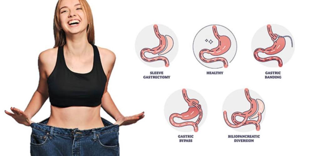 Transformative Weight Loss Surgery with Gastric Turkey