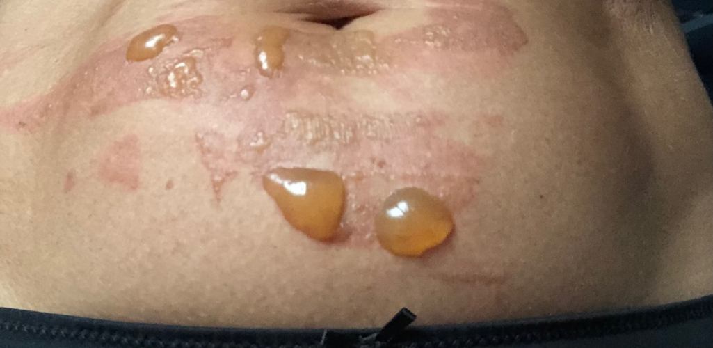 Everything you need to know about burns.