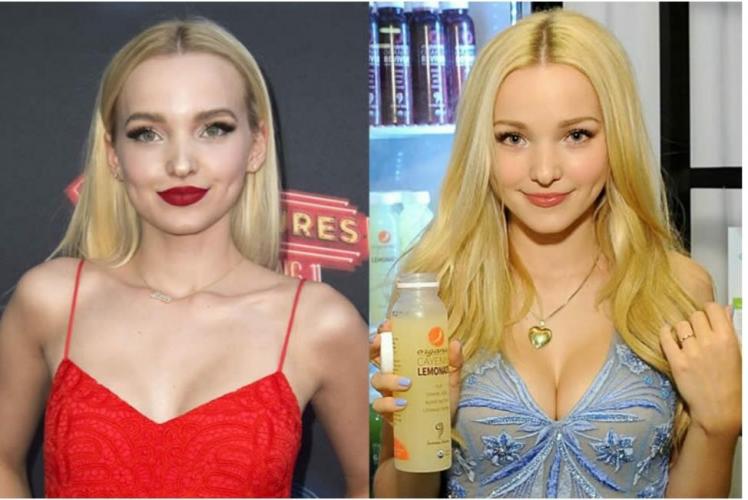  Dove Cameron Plastic Surgery Pictures From Childhood to Now