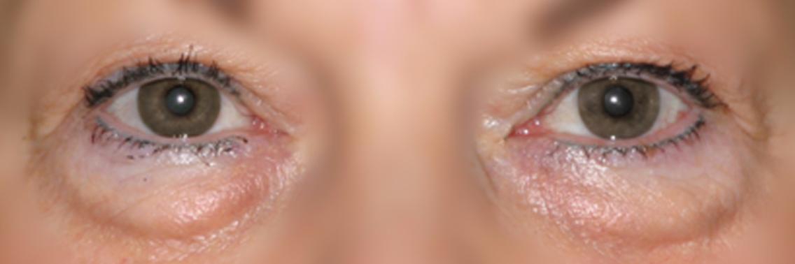 Hoe je op natuurlijke manier komaf maakt met  wallen onder je ogen | Yoors World