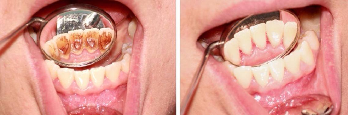 Hoe je van tandplak en tandvleesaandoeningen afkomt zonder dure behandelingen? | Yoors World