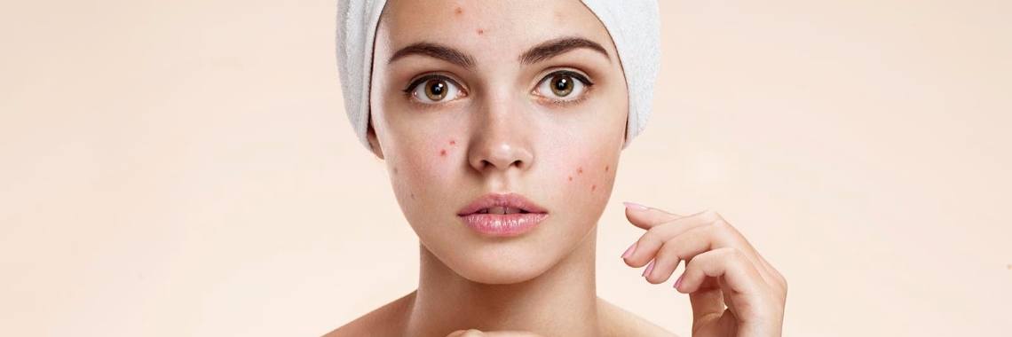 Kun je acne genezen met appelazijn? | Yoors World