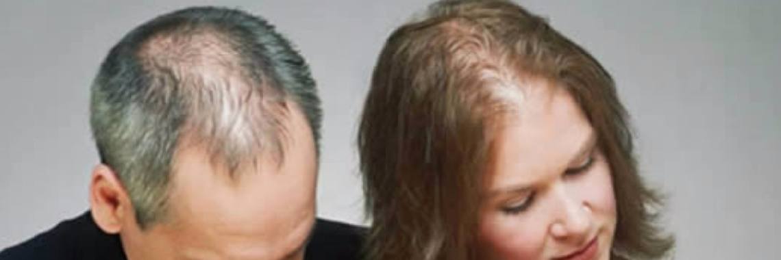 Stop nu haaruitval op natuurlijke wijze | Yoors World