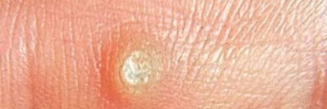 Verwijder zelf eenvoudig en pijnloos  je wratten. | Yoors World