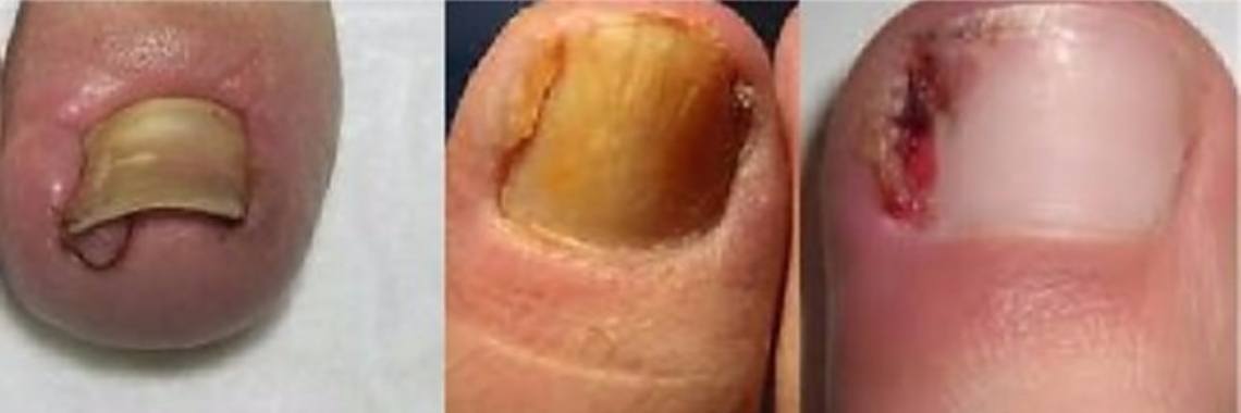 Zo kan je je ingegroeide teennagel genezen zonder chirurgische ingreep | Yoors World