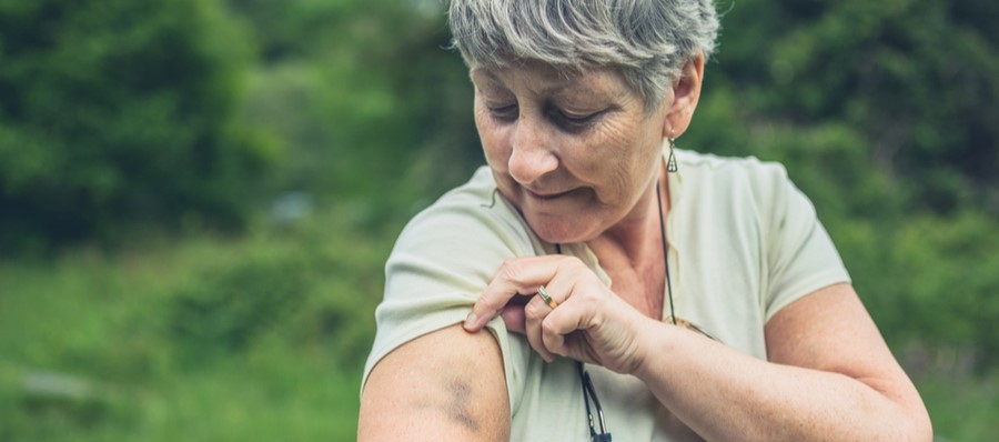 Blauwe plekken: Hoe kom je er vanaf? | leefnugezonder