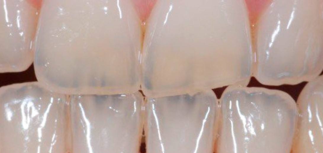 Do you know why your teeth become transparent? - Yoors - Why Are My Teeth See Through At The Tips