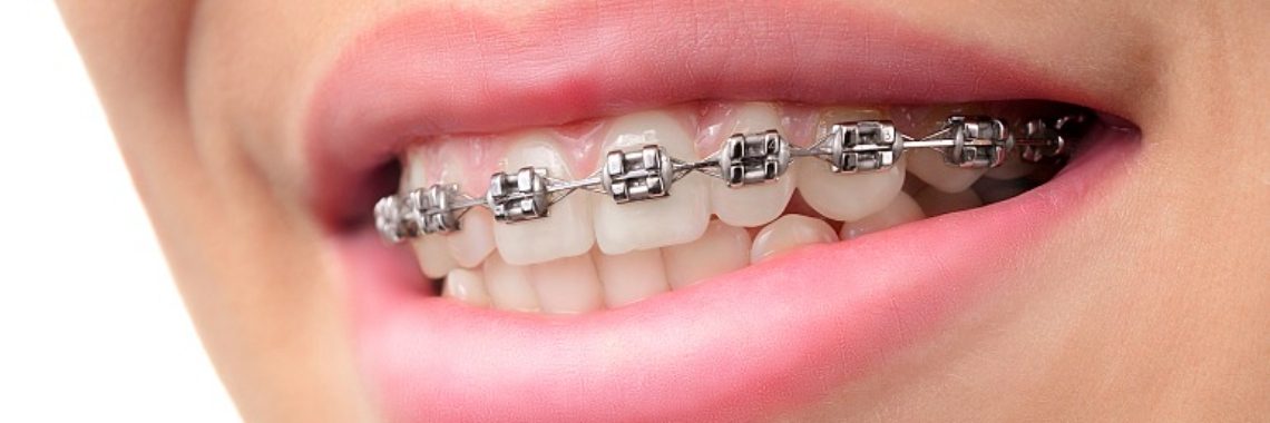 can-insurance-cover-braces