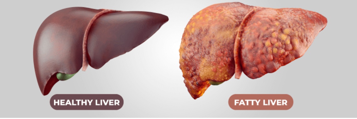 Fatty Liver | Hiruni  T